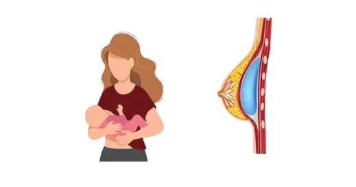 تأثیر جراحی زیبایی پستان بر شیردهی؛ بررسی انواع جراحی و نقش مجاری شیردهی