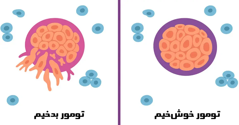 تفاوت توده خوشخیم و بدخیم پستان؛ تشخیص، علائم و روشهای بررسی توسط متخصص جراحی پستان