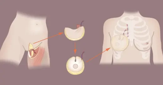 تفاوت جراحی زیبایی پستان با بازسازی بعد از سرطان؛ راهنمای علمی برای انتخاب روش مناسب