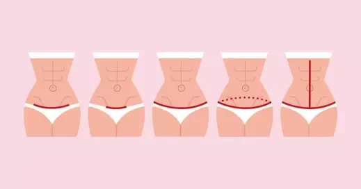 ابدومینوپلاستی چیست؟ جراحی زیبایی شکم برای حذف پوست اضافه