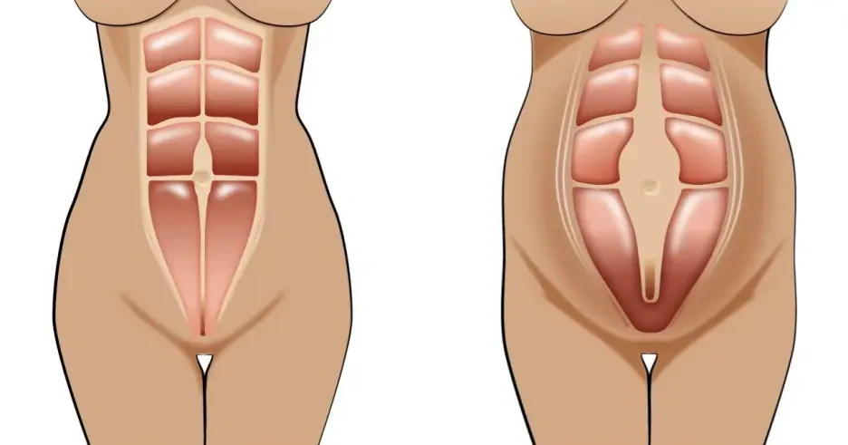 جراحی شکم بعد از زایمان: چه زمانی مناسب است
